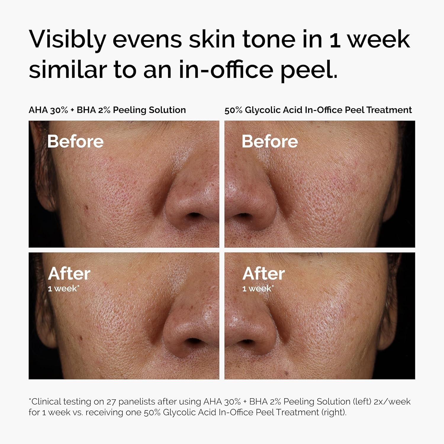The Ordinary AHA 30% + BHA 2% Peeling Solution, Advanced Exfoliating Peel for Brighter Skin(AHA 30% + BHA 2% Peeling Solution) - view 5